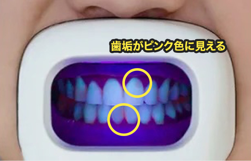 歯垢がピンク色に照らされて見える